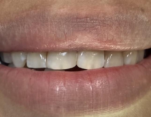 Composite Bonding after