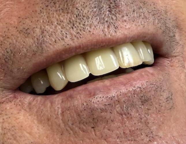 Removable partial denture after
