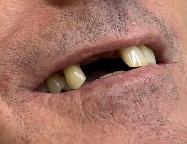 Removable partial denture before