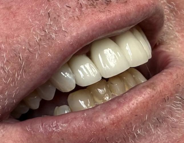 Upper Anterior Crowns after