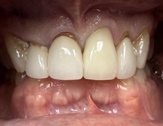 Upper Anterior Crowns before