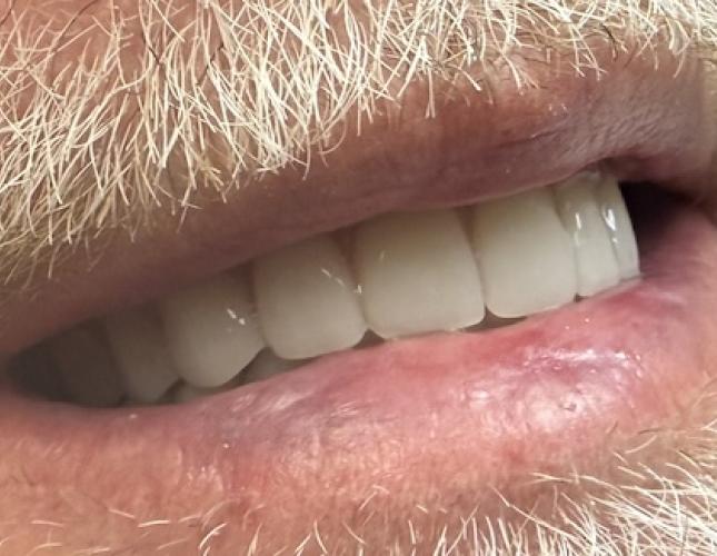 After Maxillary and Mandibular Complete Dentures