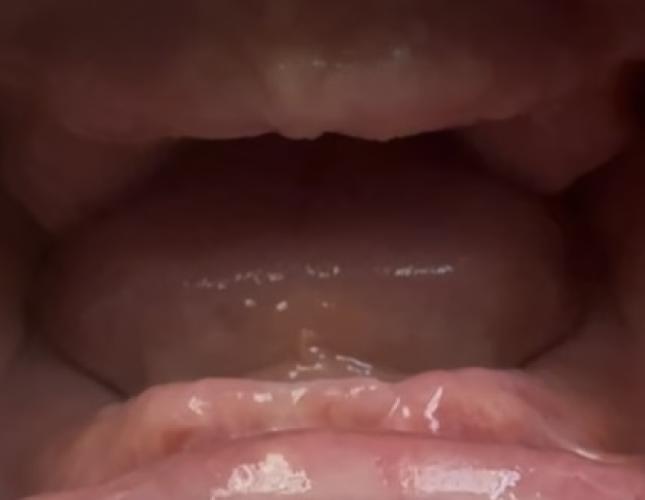 Before Maxillary and Mandibular Complete Dentures