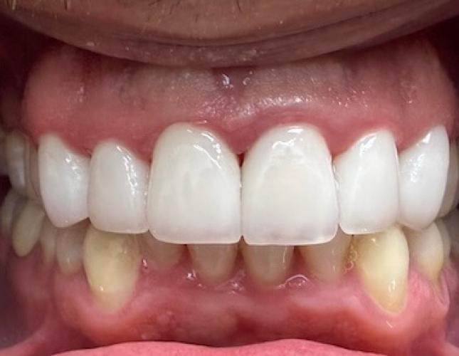 Anterior Upper Crowns After