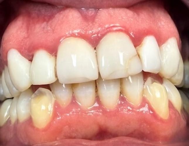 Anterior Upper Crowns Before