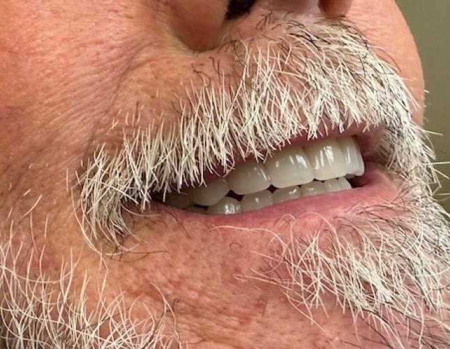 Complete Denture After